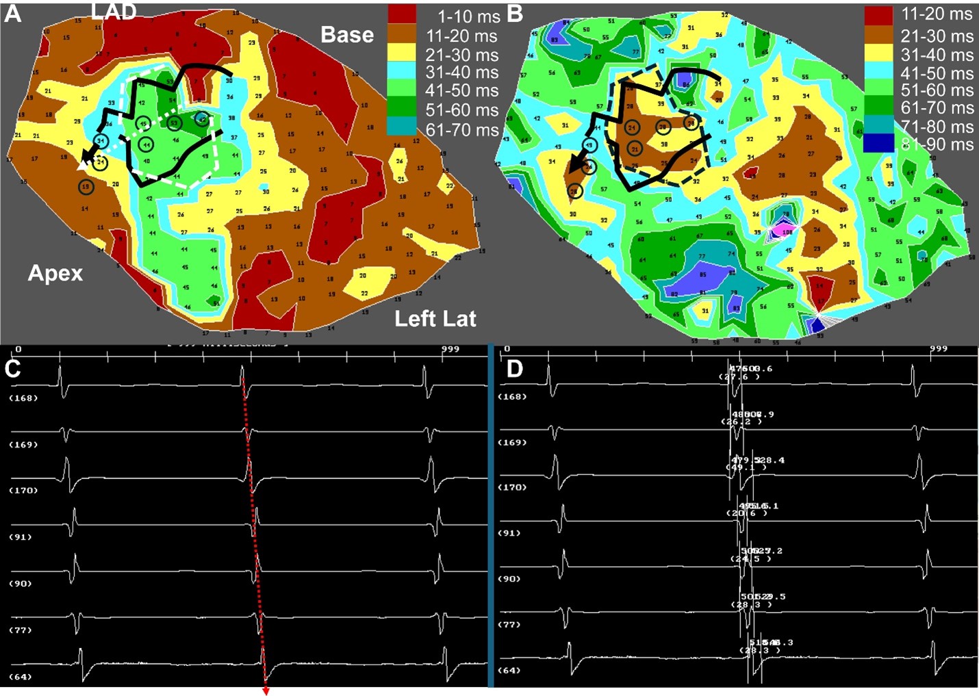 Paradigm for predicting ventricular tachycardia isthmus location, shape, and exit orientation from sinus rhythm activation and electrogram maps